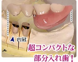 部分入れ歯